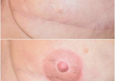 nipple-areola